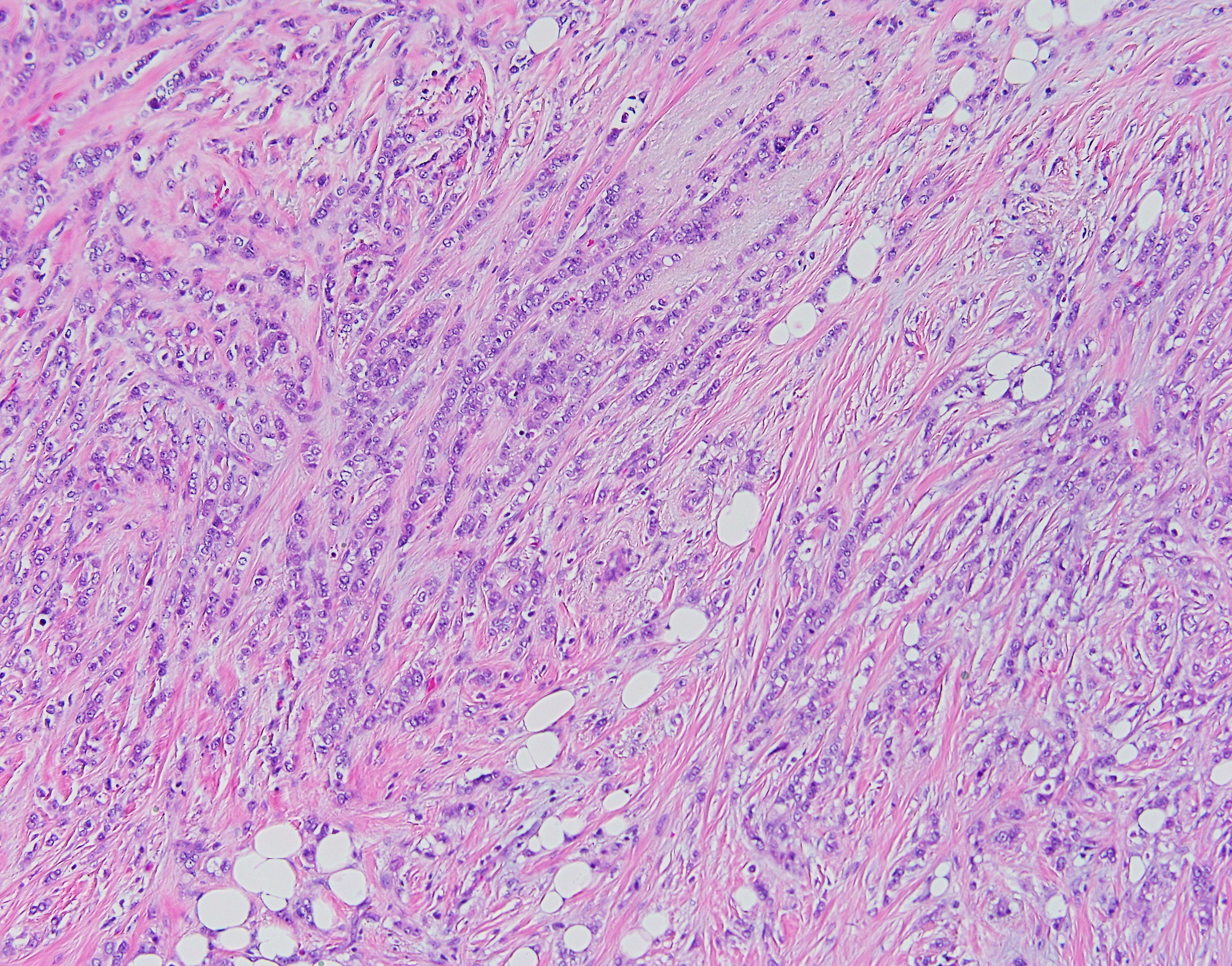 lobular carcinoma breast grade 2